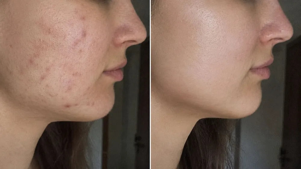 Antes y después · antiacné