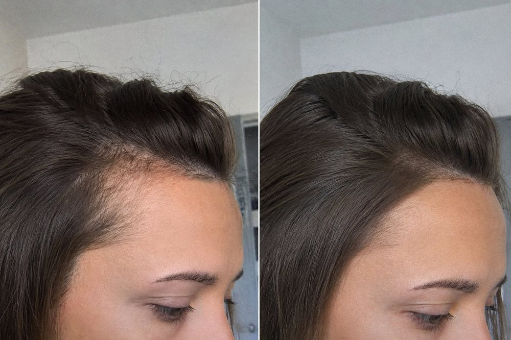 Antes y después · línea frontal