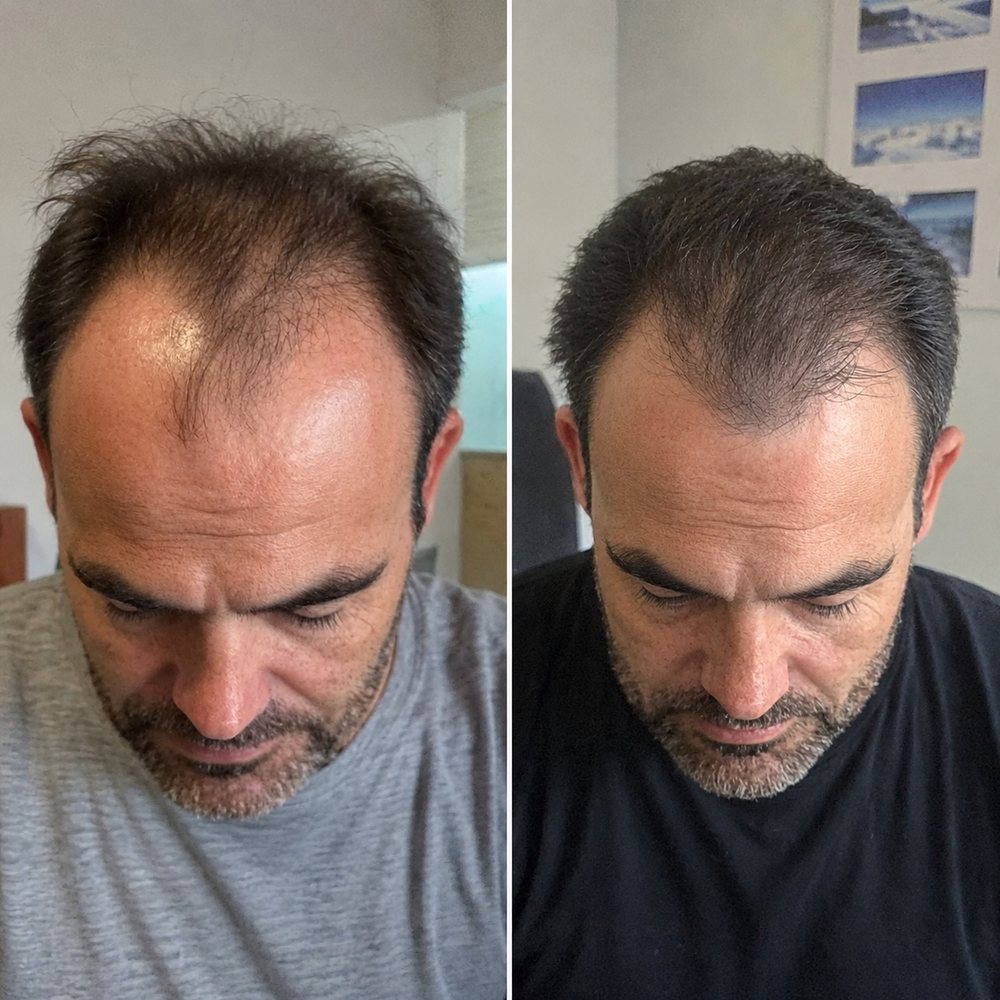 Antes y después · coronilla y entradas